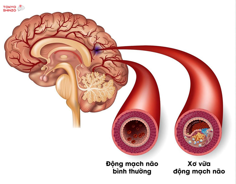 Xơ vữa mạch máu não