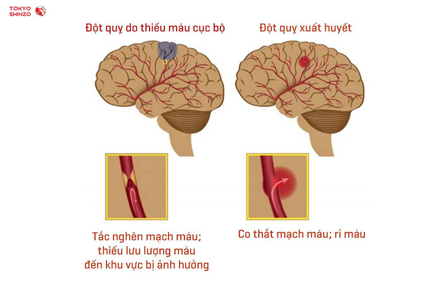 Biến chứng của tăng huyết áp thường gặp 