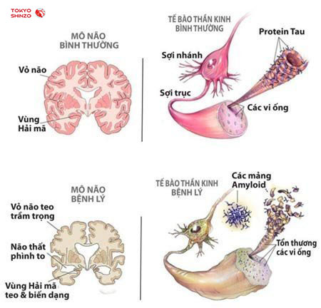 Gốc tự do làm tổn thương tế bào thần kinh khiến não teo nhỏ và thoái hóa trầm trọng.