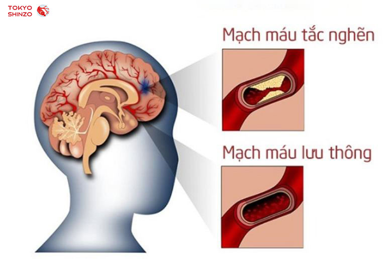 tắc nghẽn mạch máu não