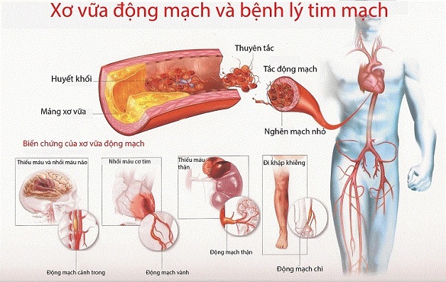 Biến chứng do xơ vữa mạch